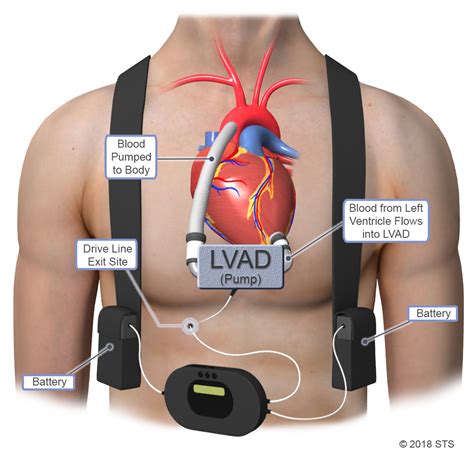 Left Ventricular Assist Device (LVAD) .